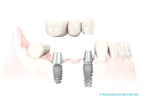 Solutions pour remplacer une dent manquante (dent provisoire/bridge/implant)